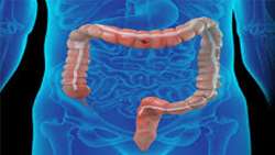 Colonoscopic Bowel Perforation in Underlying Secondary Amyloidos